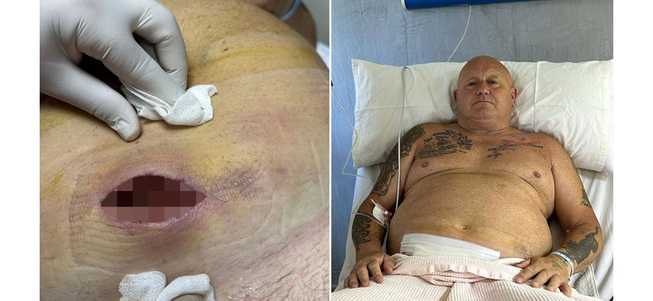 Spider bite caused flesh-eating disease in man before vacation.