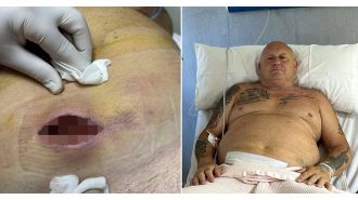 Spider bite caused flesh-eating disease in man before vacation.