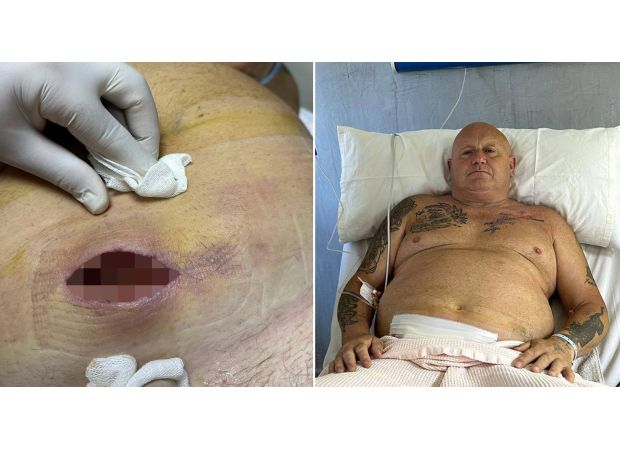 Spider bite caused flesh-eating disease in man before vacation.