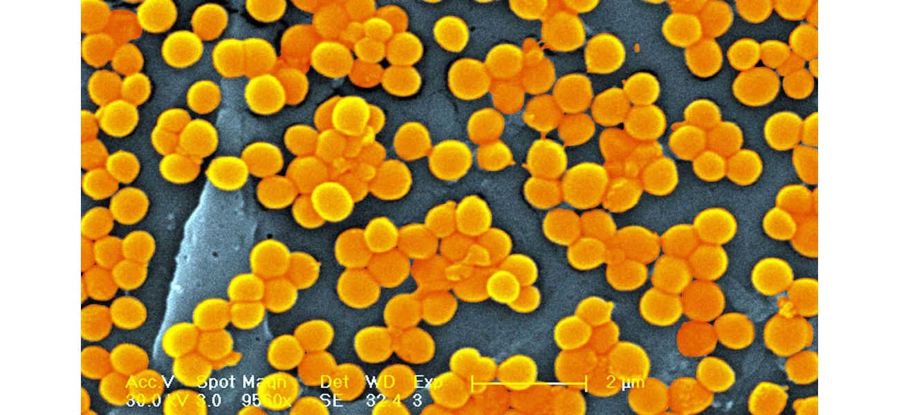 A study predicts that by 2050, superbugs may cause the death of around 40 million individuals.