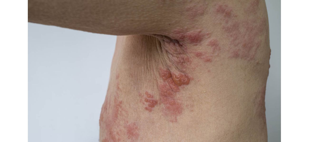 Australian citizens can now obtain a complimentary shingles vaccine.