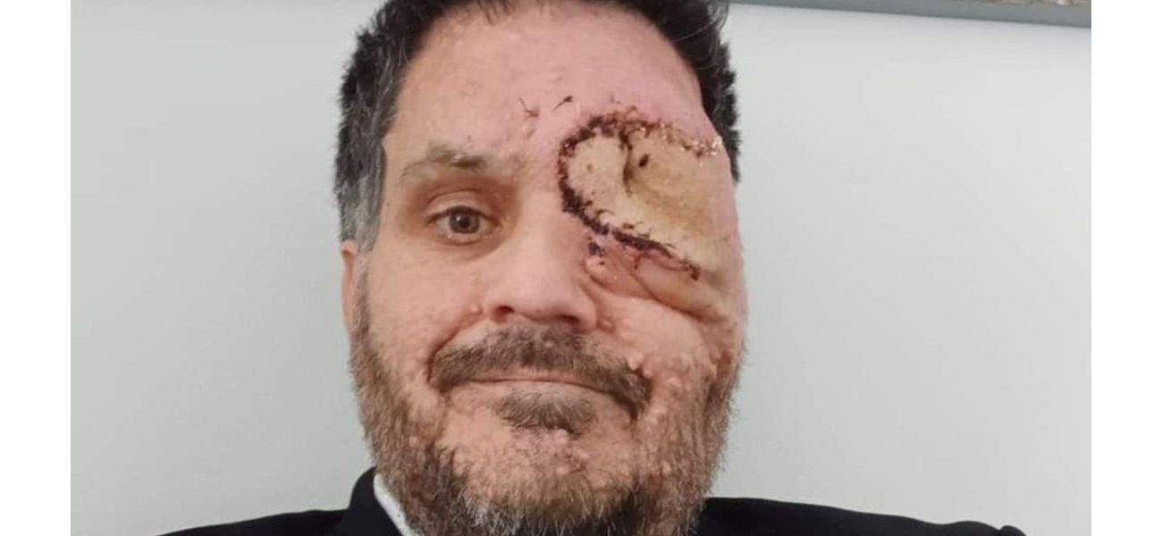 A man with a facial disfigurement was asked to leave a restaurant because his appearance was making other customers uncomfortable.