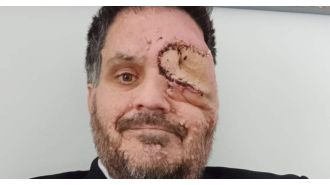 A man with a facial disfigurement was asked to leave a restaurant because his appearance was making other customers uncomfortable.
