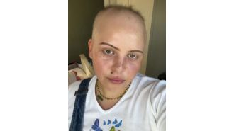 Repeated Covid infections lead to woman's complete hair loss.