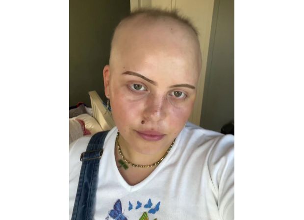 Repeated Covid infections lead to woman's complete hair loss.