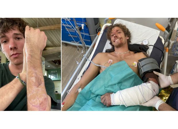 Survivor of shark attack to make earring from tooth pulled from severed arm.