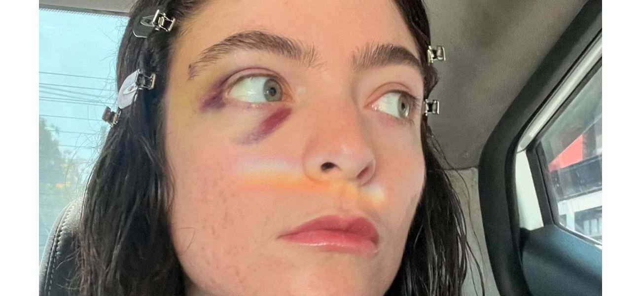Lorde's social media comeback raises worries due to her black eye.