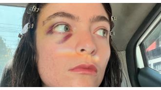 Lorde's social media comeback raises worries due to her black eye.