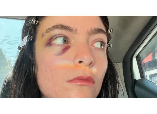 Lorde's social media comeback raises worries due to her black eye.