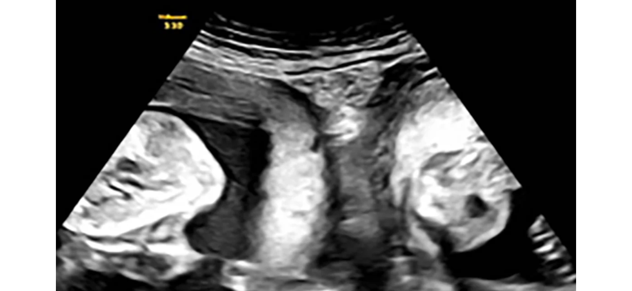 Woman with two wombs delivers twins