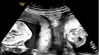 Woman with two wombs delivers twins