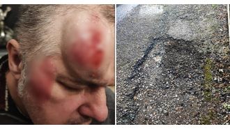 Elderly man injured severely after falling on large pothole, sustaining spinal and facial injuries.