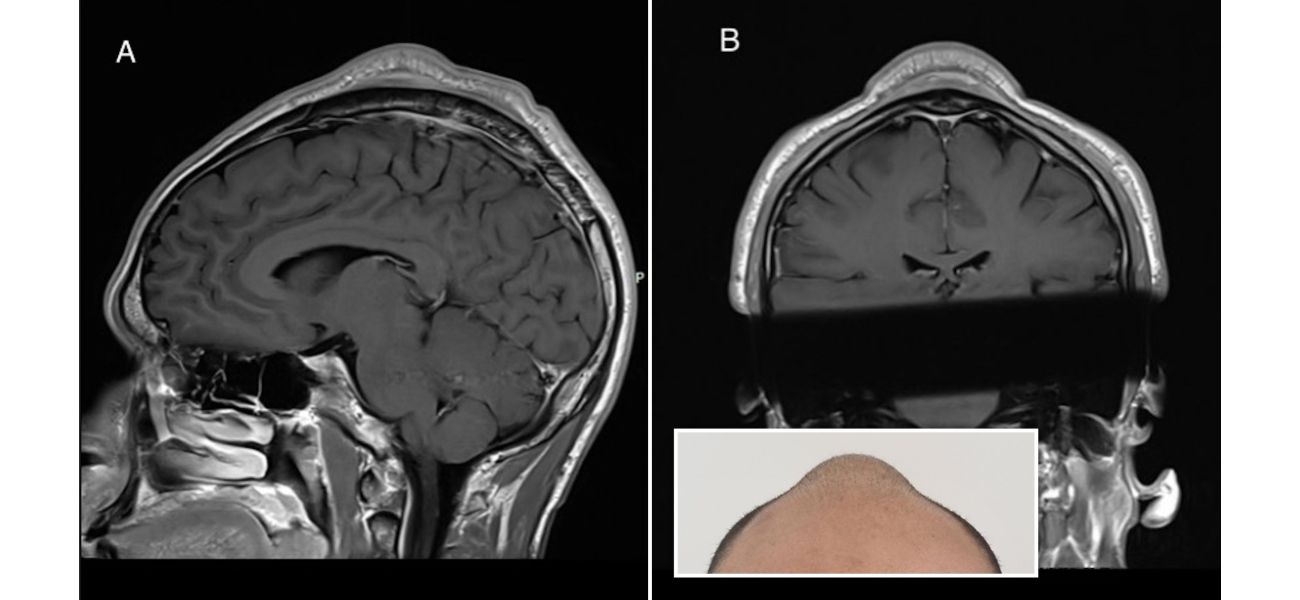Man's excessive breakdancing led to a cone-shaped bulge on his head.