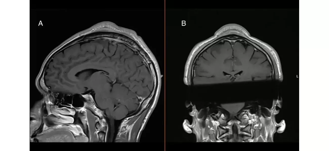 Breakdancing caused a man to develop a large tumor on his scalp after years of performing.
