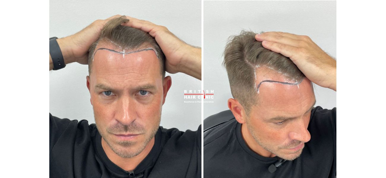 Famous Hollyoaks star reveals outcome of hair transplant procedure.