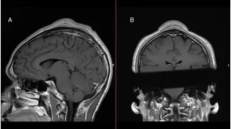 Breakdancing caused a man to develop a large tumor on his scalp after years of performing.