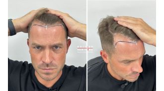 Famous Hollyoaks star reveals outcome of hair transplant procedure.