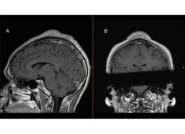 Breakdancing caused a man to develop a large tumor on his scalp after years of performing.