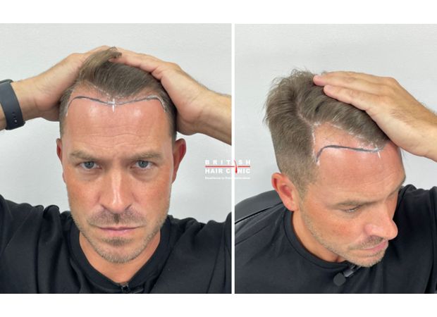 Famous Hollyoaks star reveals outcome of hair transplant procedure.