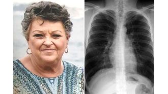 One out of 13 Australians over 40 are affected by this lung disease, but half are unaware of it.