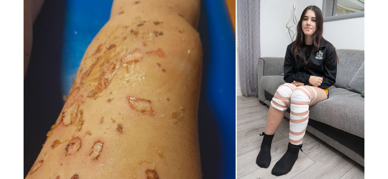 A girl's skin was burned by molten plastic when a boy kicked a burning lighter at her.