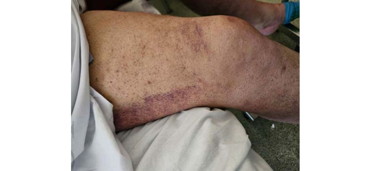 Australian man diagnosed with scurvy as a bleak sign of current times.