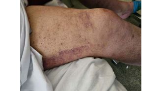 Australian man diagnosed with scurvy as a bleak sign of current times.