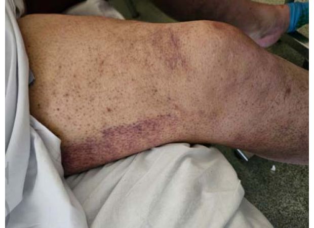 Australian man diagnosed with scurvy as a bleak sign of current times.