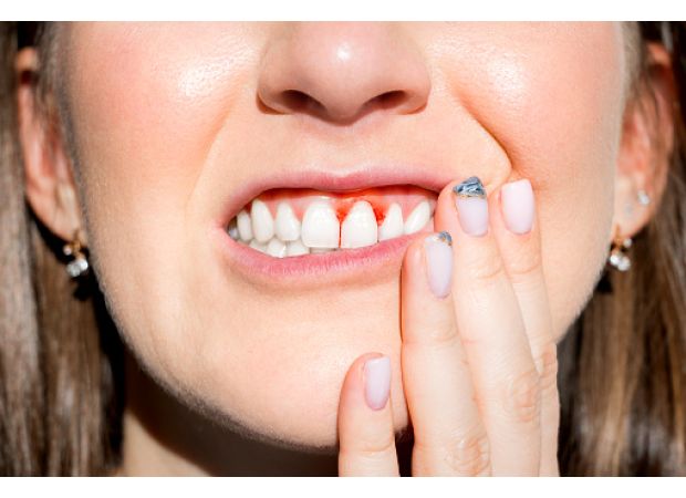 The rising cost of living is causing a resurgence of scurvy - but what exactly is it?