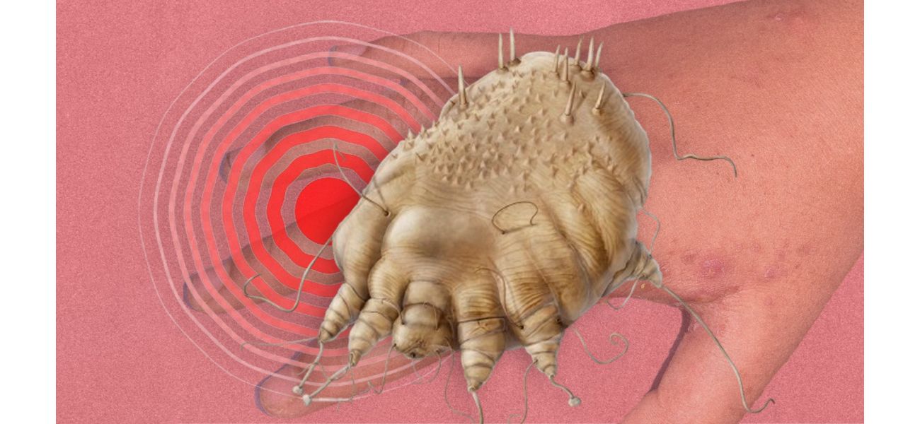 Alert: Scabies cases increasing, know the symptoms.