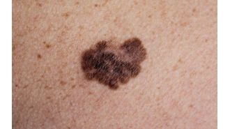 New funding of $10 million for skin cancer screening studies.