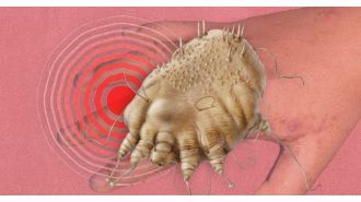 Alert: Scabies cases increasing, know the symptoms.