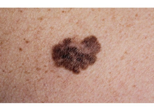 New funding of $10 million for skin cancer screening studies.