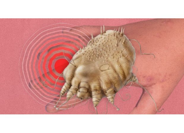 Alert: Scabies cases increasing, know the symptoms.