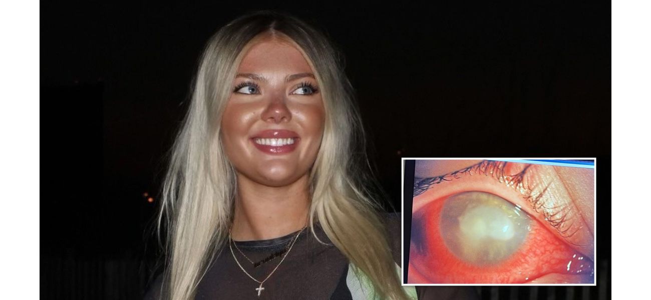 Contact lens mixup leads to blindness as parasites take over woman's eye