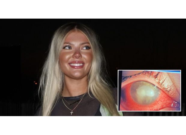Contact lens mixup leads to blindness as parasites take over woman's eye