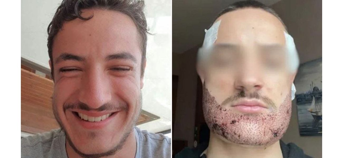 Tragic death of student following failed beard transplant by ‘Turkish real estate agent’