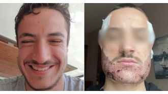 Tragic death of student following failed beard transplant by ‘Turkish real estate agent’