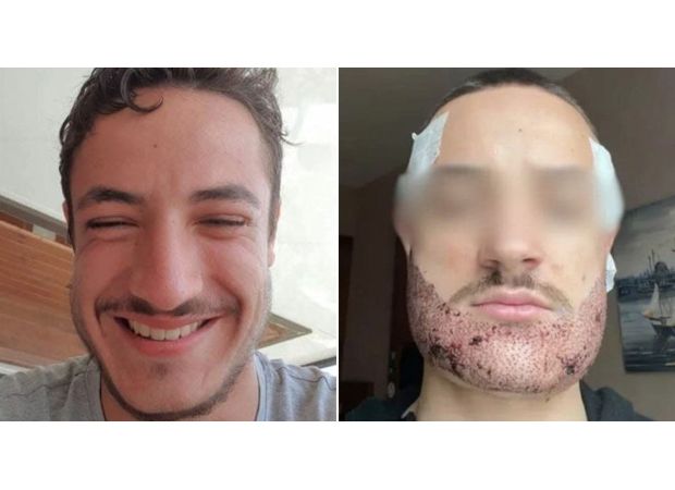 Tragic death of student following failed beard transplant by ‘Turkish real estate agent’