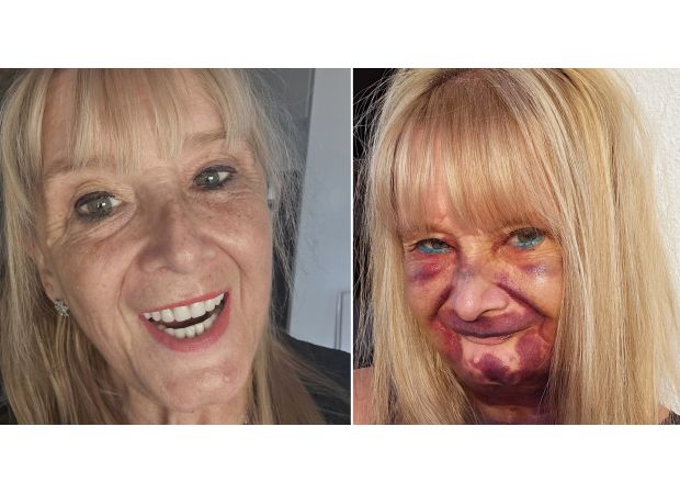 Grandmother spends a lot of money on new set of dentures and is very happy with the results.