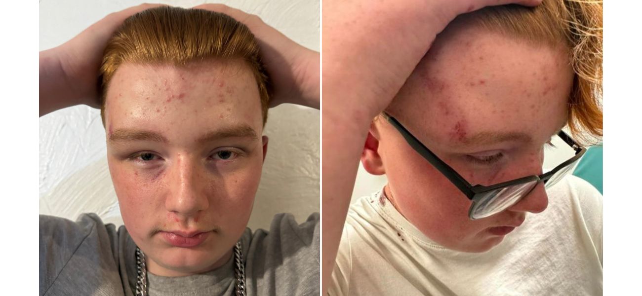 A 14-year-old autistic boy was attacked by a group of teenagers who stabbed him in the head and attempted to set him on fire.