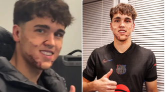 Injured Barcelona player suffers brutal facial injuries after being kicked during match.