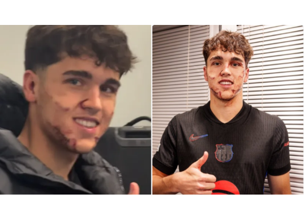 Injured Barcelona player suffers brutal facial injuries after being kicked during match.