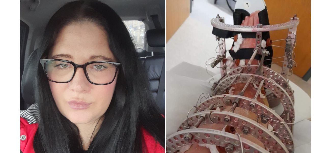 Woman's leg amputated after falling on stairs at home.