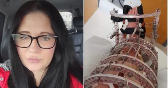 Woman's leg amputated after falling on stairs at home.