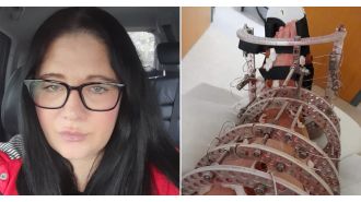 Woman's leg amputated after falling on stairs at home.