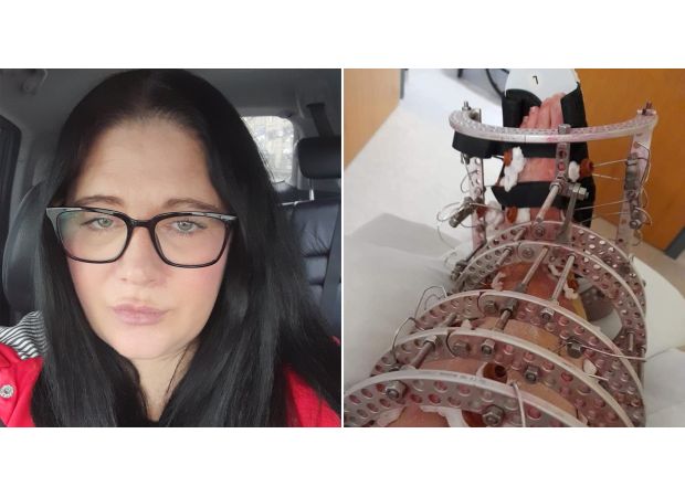 Woman's leg amputated after falling on stairs at home.