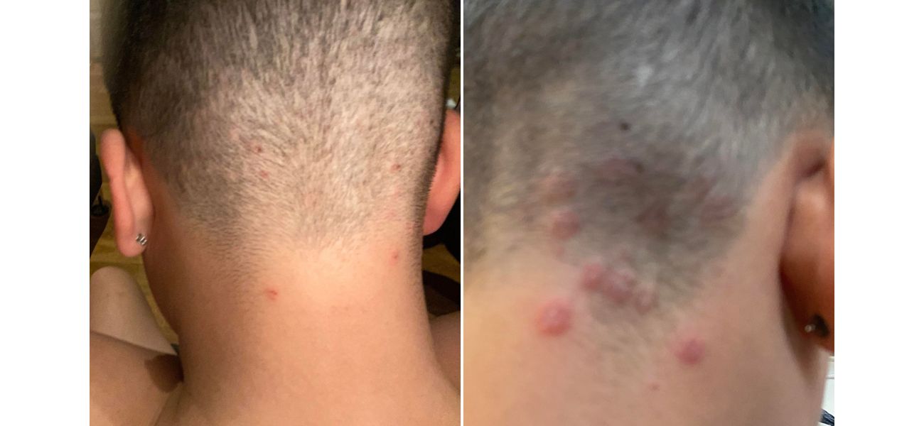 Warning issued due to high rate of ringworm caused by popular men's haircut.