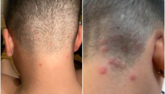Warning issued due to high rate of ringworm caused by popular men's haircut.