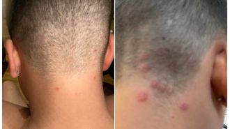 Warning issued due to high rate of ringworm caused by popular men's haircut.